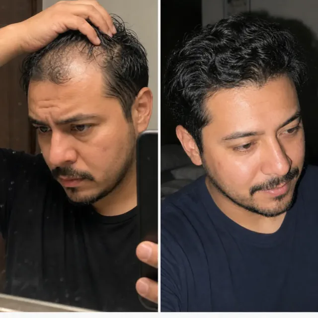 Cuero cabelludo de Ricardo antes de empezar la rutina y después de 5 meses